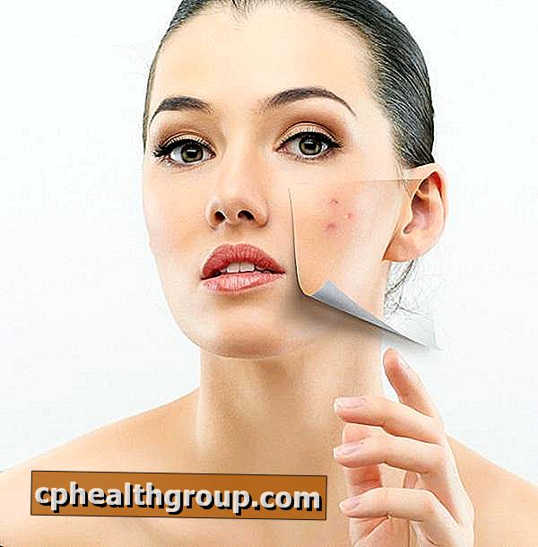 Quais são os sintomas da acne