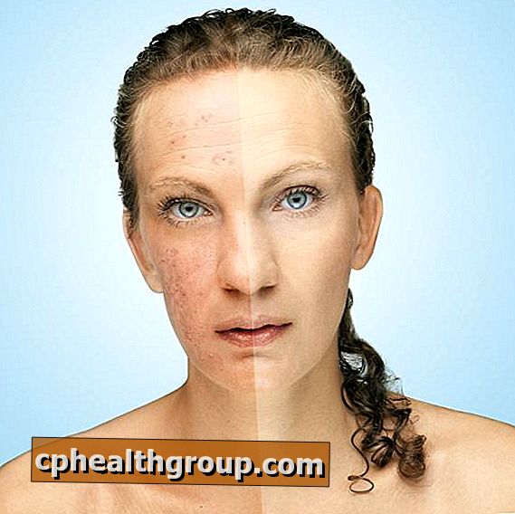 Causas da acne em adultos