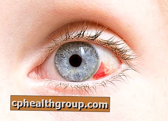 100% -os látás mindkét szemben kezelés népi gyógyszerekkel gyenge látás