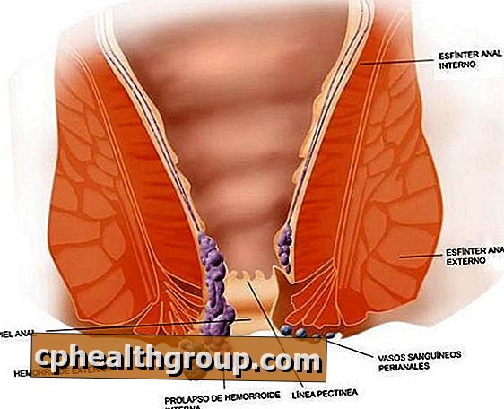 Hvordan helbrede hemorroider