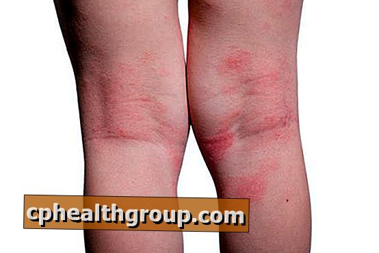 Vörös foltok jelentek meg a lábakon Milyen betegségre utalnak a vörös foltok?