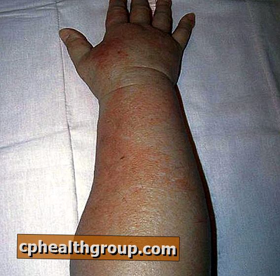 Come trattare il linfedema nel braccio