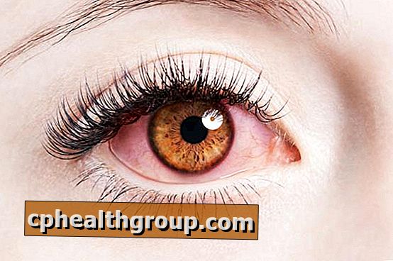 Природне лікування очного розацеа