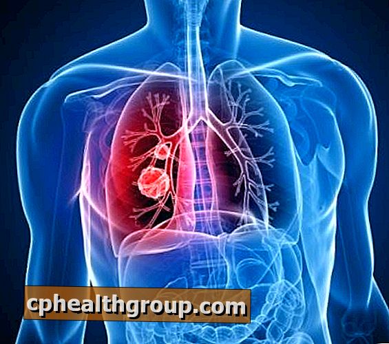 Hvordan behandle lungebetennelse med hjemmemedisiner