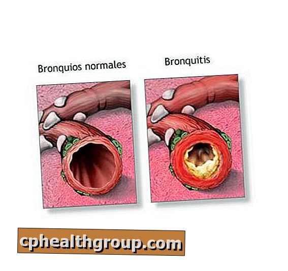 Wat zijn de symptomen van bronchitis?