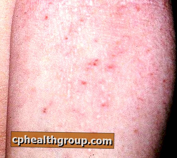 Como tratar a dermatite atópica