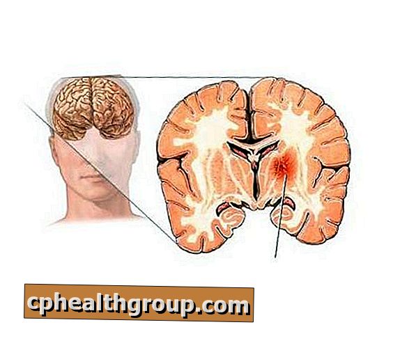 Comment reconnaître un accident vasculaire cérébral