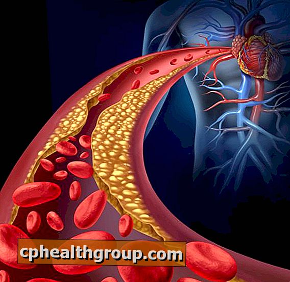 Kokie yra arteriosklerozės simptomai?