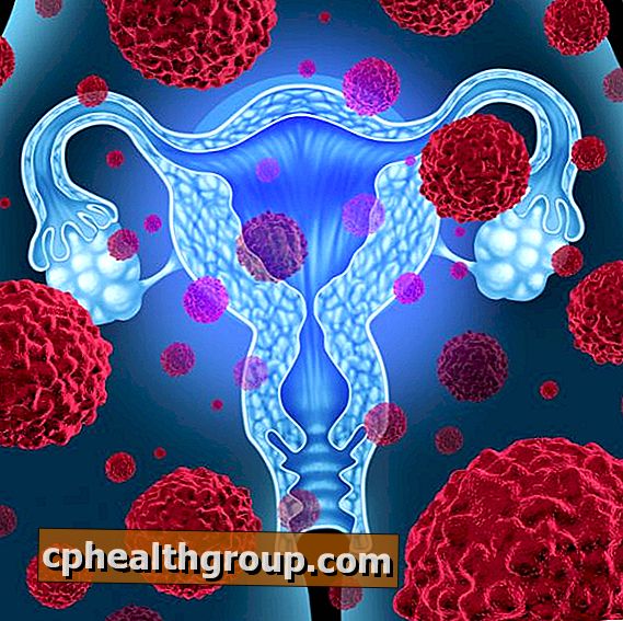 Cum să tratați cancerul uterin