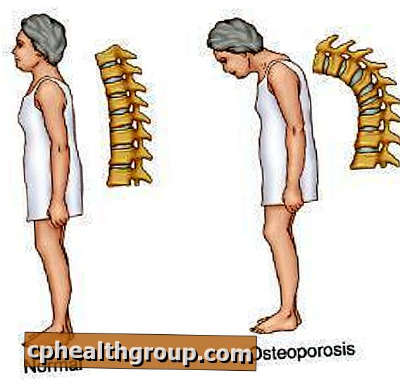 Hvordan behandle osteoporose