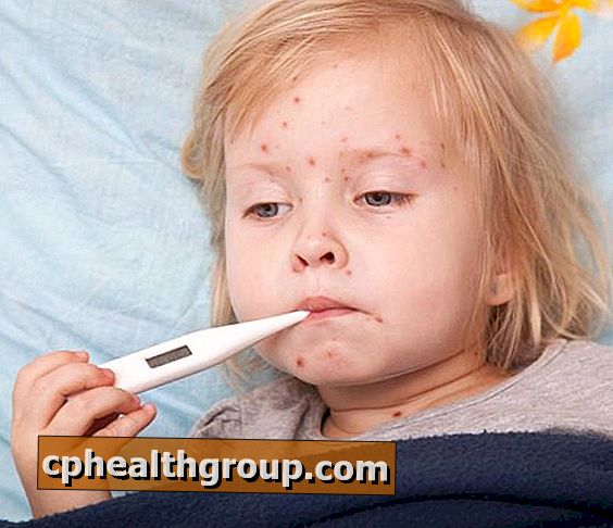 Comment éviter la propagation de la varicelle