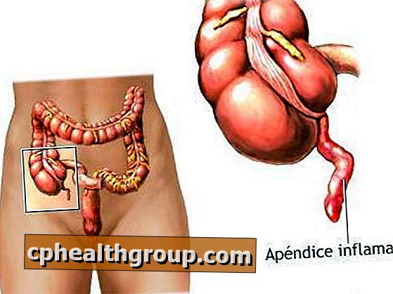 Kaip gydyti apendicitą