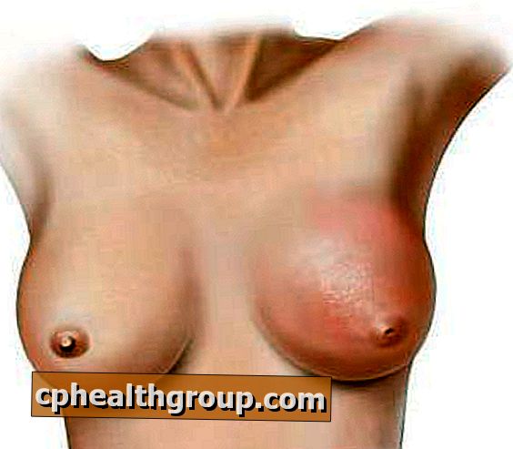 Kā novērst limfedēmu krūts vēža gadījumā