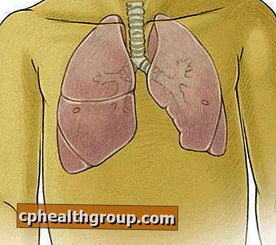 Kako liječiti plućni edem