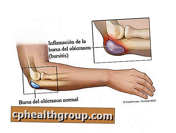 Burzitis koljena tretirana sa soli