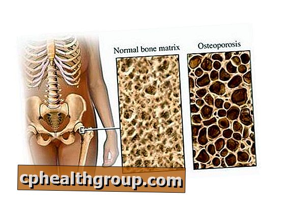 Was sind die Risikofaktoren für Osteoporose?
