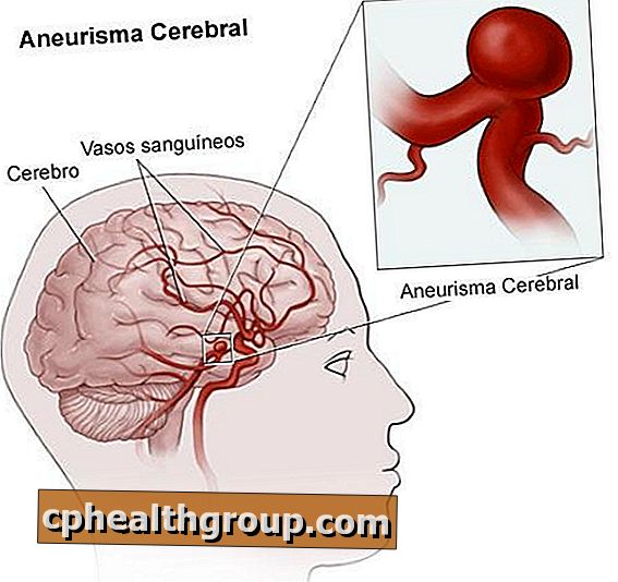 Mitkä ovat aivojen aneurysmin syyt