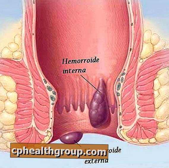 Kakšni so simptomi hemoroidov