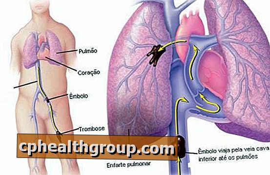 Kako zdraviti pljučno embolijo - akutna faza