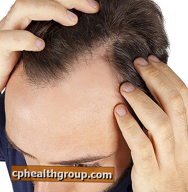 Tünetei seborrhea a fejbőrt. seborrhea fejbőr kezelés otthon