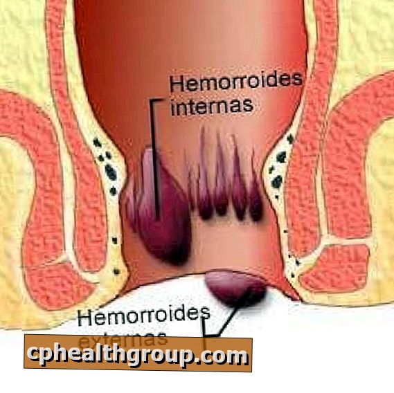 Hvordan hemorroider klassifiseres