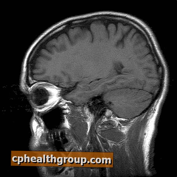 Kakšni so simptomi možganske anevrizme?