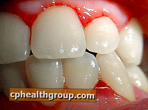 Kodėl dantenų kraujavimas