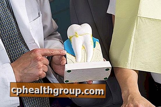 Vzroki za periodontitis