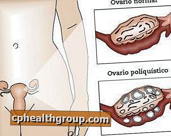 Jaké jsou příznaky polycystických vaječníků?