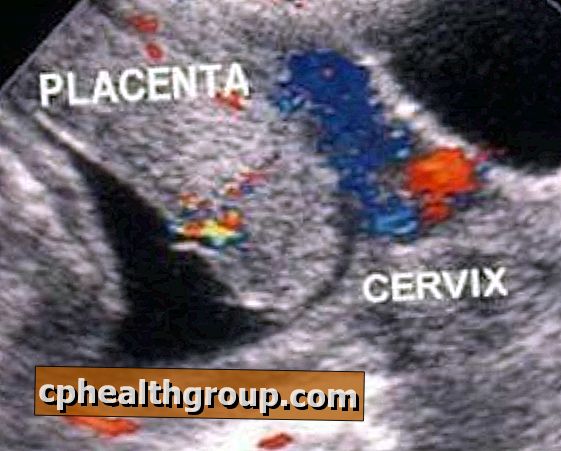 Jak se vyvíjí předčasné oddělení placenty