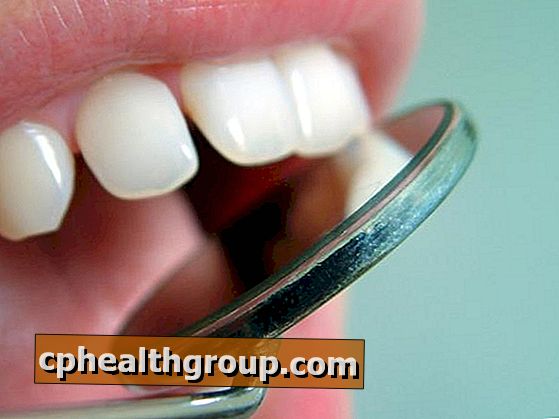 Kako prikriti odvojene zube