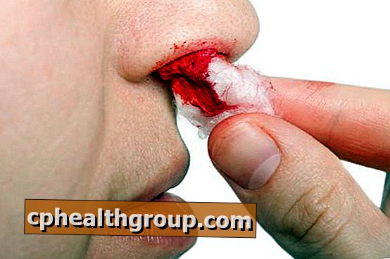Przyczyny krwawienia z nosa