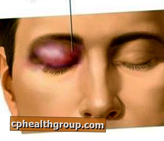 Kuidas ravida silma kahjustusi