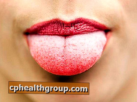 Kako izliječiti opekline na jeziku